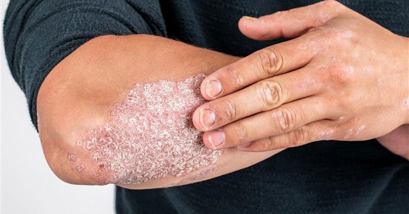 Psoriasis research - Press Office - Newcastle University