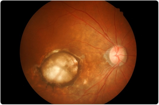Macular Degeneration Treatment