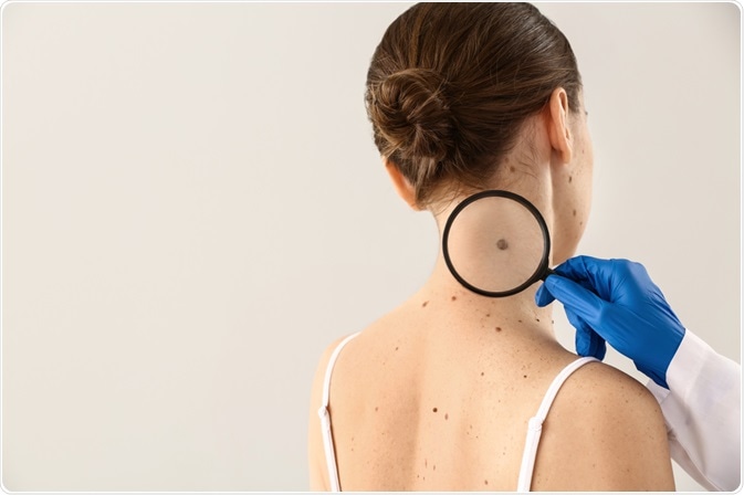 Melanoma Symptoms and Cause