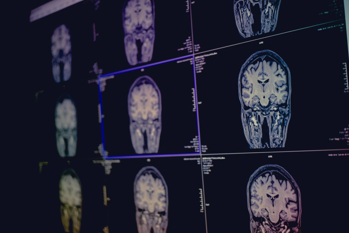 What is Mild Cognitive Impairment?