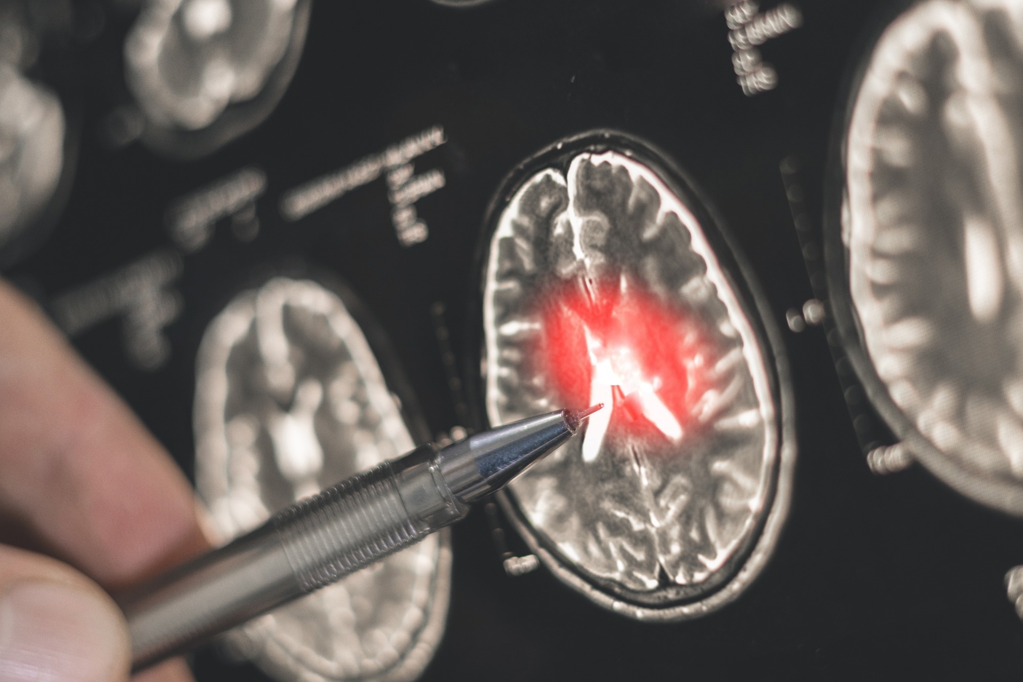 High-dose flu shots inked to lower Alzheimer's dementia risk in older adults