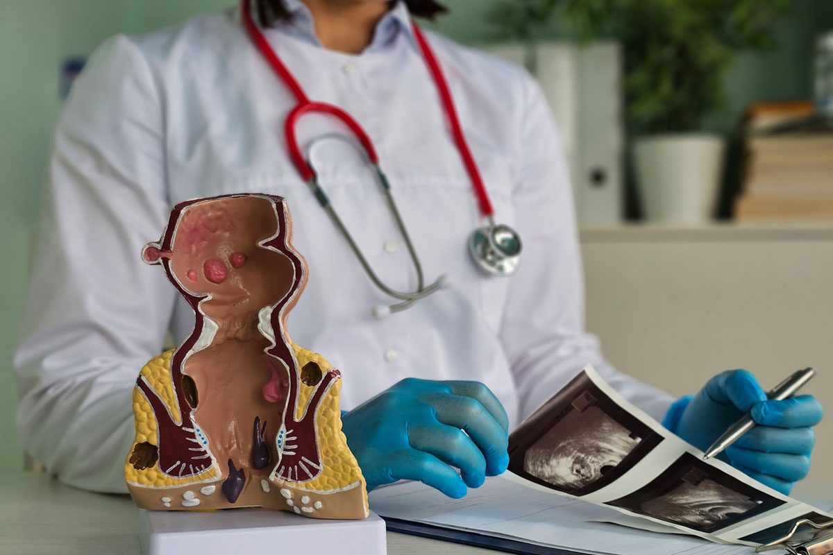 Solitary Rectal Ulcer Syndrome in a Patient Taking Fluoxetine