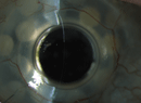 Artificial Cornea Intelligence