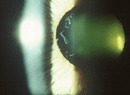 ARVO: Glaucoma