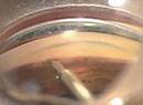 Managing the Post-op Glaucoma Patient