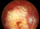 Food for Thought: Diet, Genetics and AMD