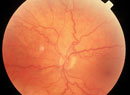 Recognizing Abnormal Vasculature