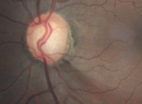 Disc Hemorrhage Blues
