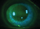 Glaucoma Therapy: Don’t Forget the Ocular Surface