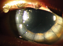 An OD’s Guide to Corneal Transplant Options