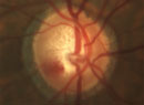 Glaucoma: How to Build a Better Baseline
