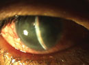 Equilibrium in the Eye