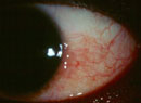 Red Eye Remedies: New and Tried-and-True