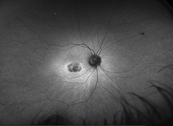 Plaquenil Toxicity: How to Avoid this Bullseye