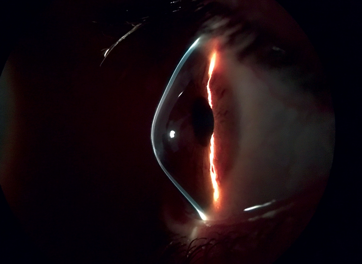 Trends, Challenges and Controversies in Keratoconus
