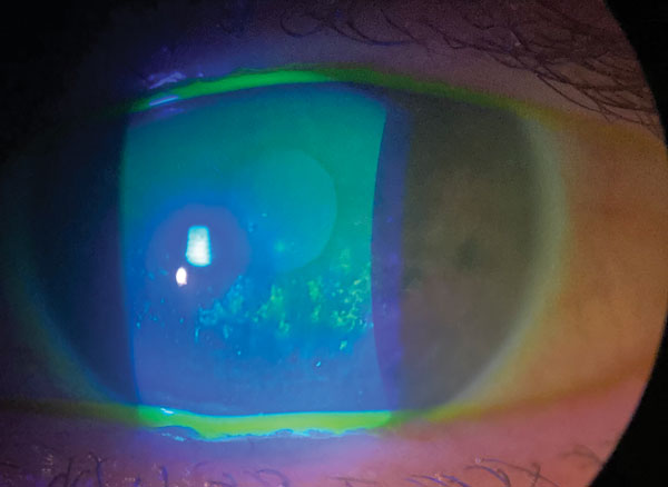 Dry Eye Drugs: What’s New and What’s Next