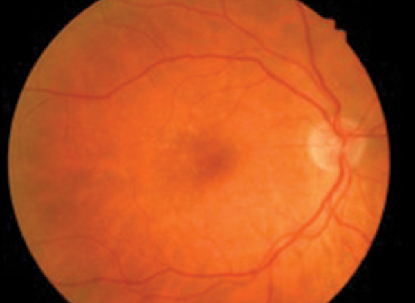 Nutrition and the Retina: Help Patients Help Themselves