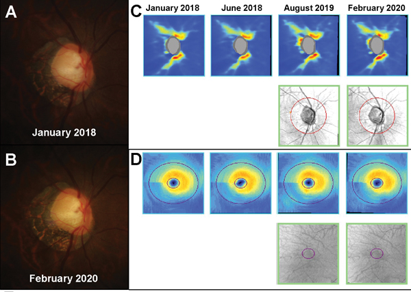 Glaucoma Care Beyond the Basics: Advanced Tips and Considerations
