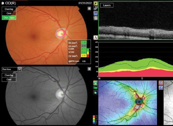 Avoid These Common Glaucoma Mistakes