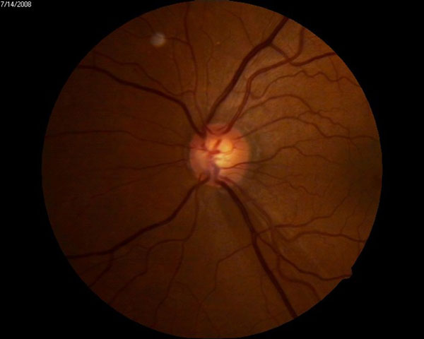 Glaucoma: Pearls for Improving the Patient Experience