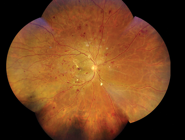 Diabetic Eye Disease: A Comprehensive Look at the Optometrist’s Role