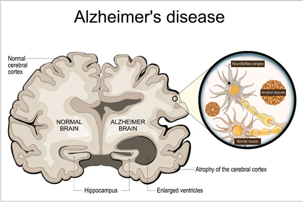 Neurodegenerative Disease: Uncovering the Ocular Connection