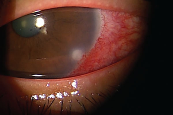 Systemic Medication Concerns for Corneas