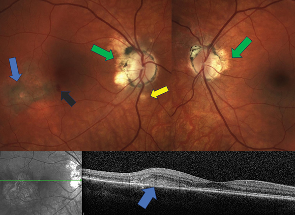 Rapid-Fire Retina: Quick, Name That Condition!