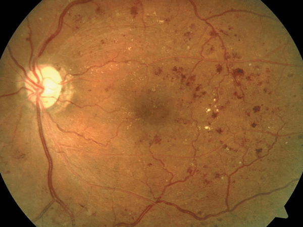 Beyond BCVA: How to Improve Your Visual Function Evaluation in DR Patients