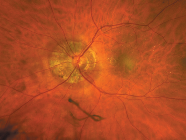 My Patient Has High Myopia... Now What?