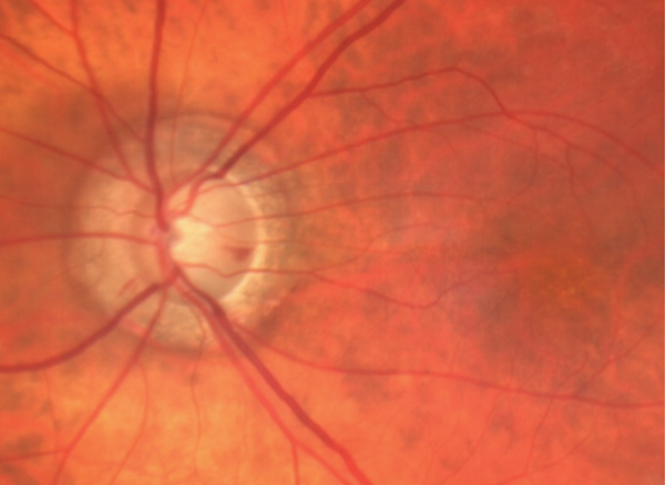 Lesson: Optic Nerve Disorders: How They Manifest and What They Mean