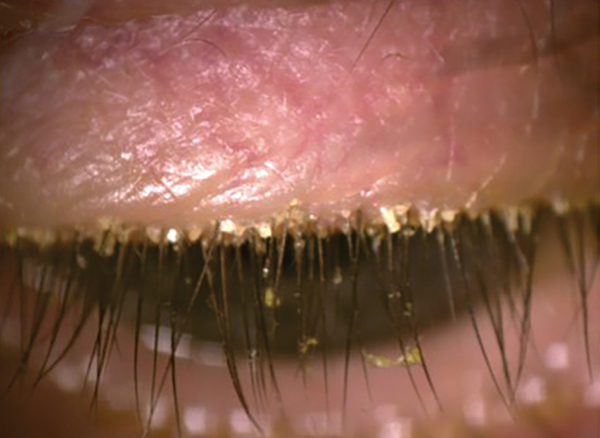 Lesson: A Stepwise Approach to Diagnosing Dry Eye Disease