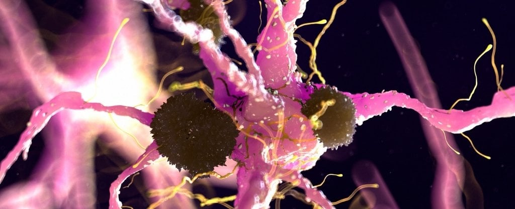 Parkinson's Discovery Suggests We Could Already Have an FDA-Approved Treatment : ScienceAlert