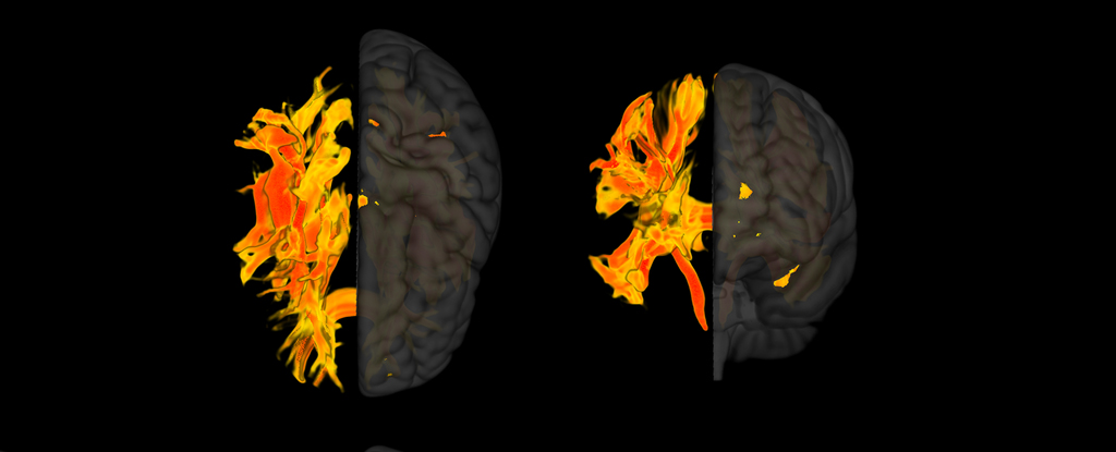 World First: Dementia Linked to Brain Abnormalities From High Blood Pressure : ScienceAlert