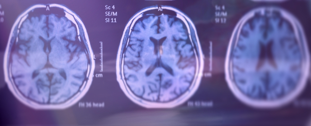 New Genetic Form of Alzheimer's Identified in People With Common Risk Factor : ScienceAlert