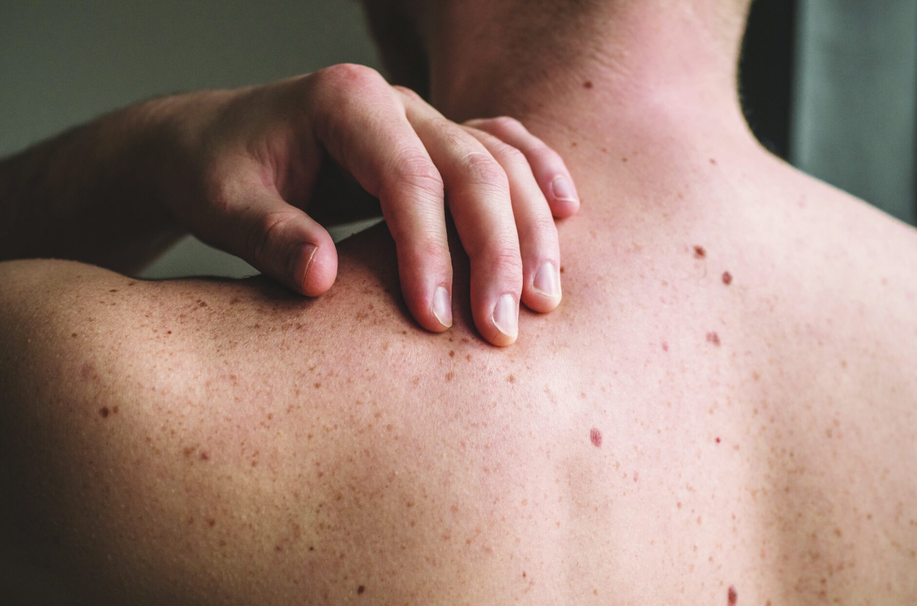 Ask the Expert: Mohs Surgery and Melanoma