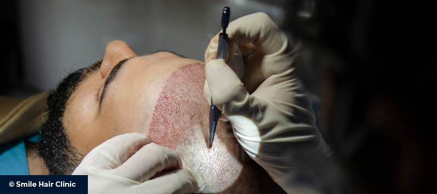 What Should I Do Before Hair Transplant - Smile Hair Clinic