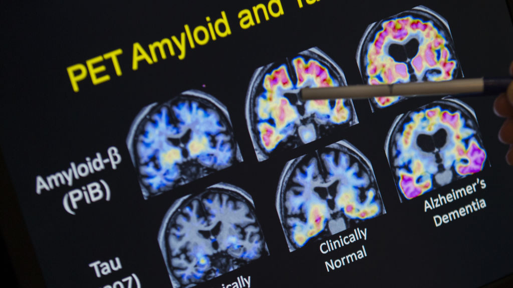 J&J’s novel Alzheimer’s drug posdinemab fails in key trial | STAT