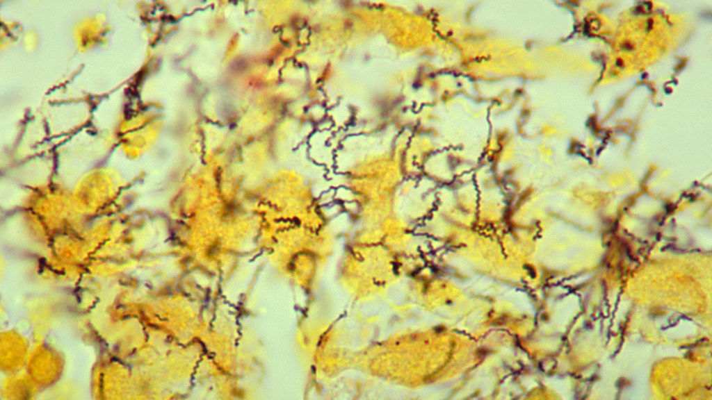 See how syphilis rates are spiking across the country