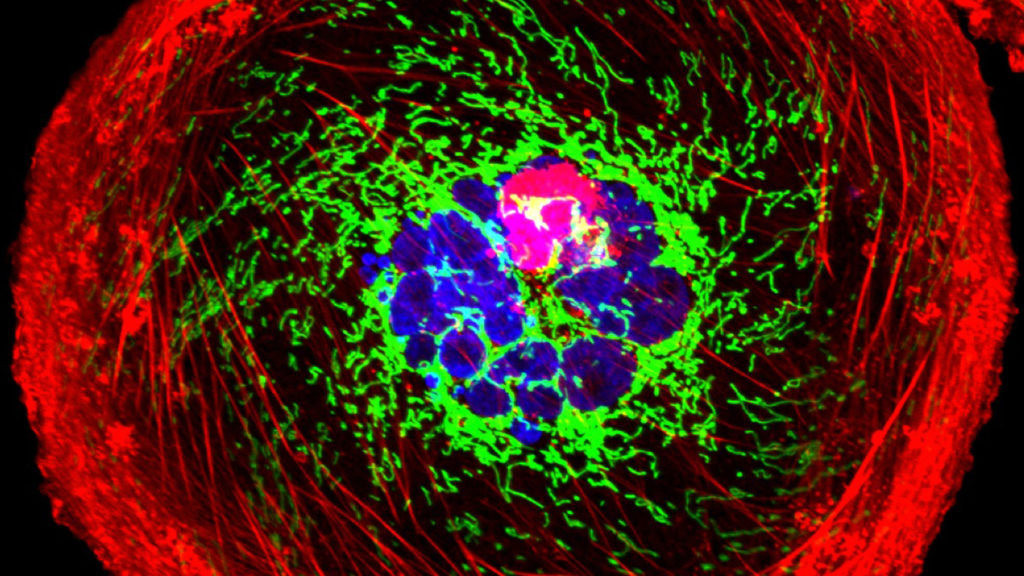 Triple-negative breast cancer reflects health inequities in the U.S. | STAT