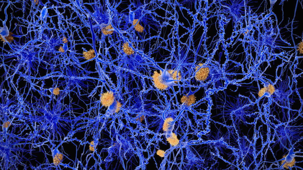 Bad medicine: aducanumab is a lackluster drug with a high cost | STAT
