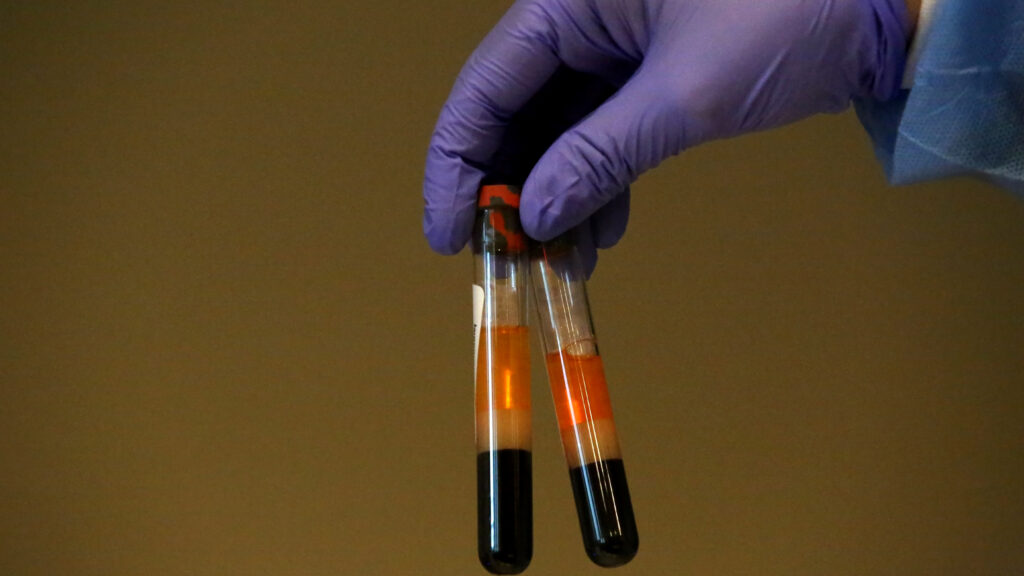 Results from TSH tests vary in different brands of lab machines | STAT