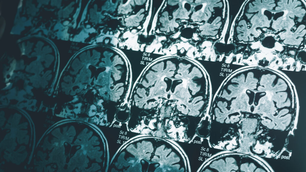 Expert panel votes down Biogen’s Alzheimer’s drug, and rebukes FDA