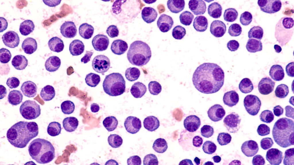 CAR-T trial on smoldering multiple myeloma raises long-term hopes | STAT