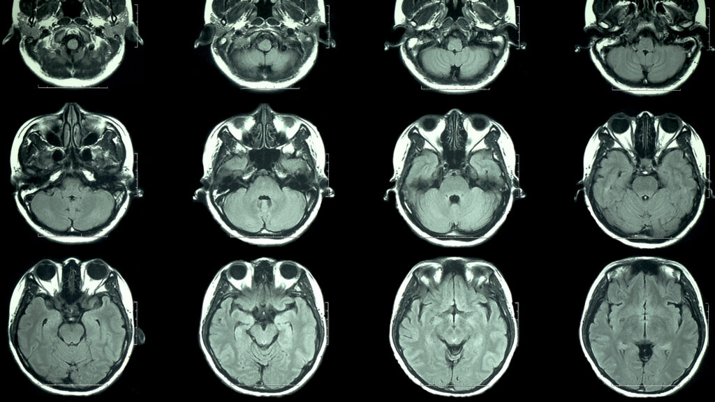 Alzheimer’s treatment slowed cognitive decline in closely watched trial