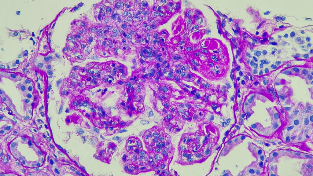 Autoimmune field buoyed by successes with CAR-T treatments | STAT