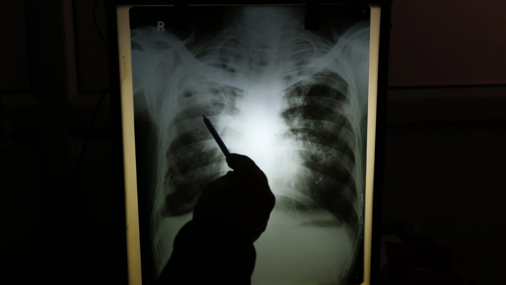 Tuberculosis patients need more than just free medication | STAT