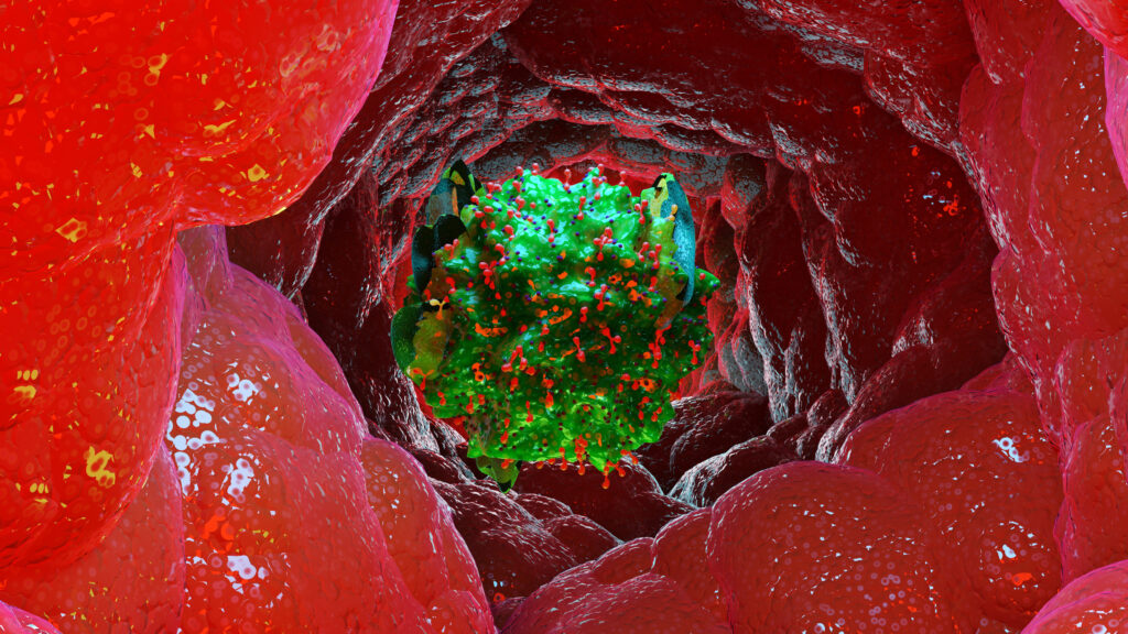 Immune cells and nerve overgrowth may explain recurring UTI pain