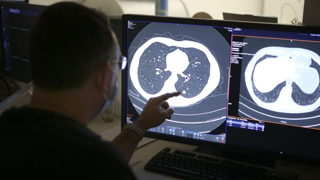 Summit therapy beat Merck blockbuster Keytruda in late-stage lung cancer trial