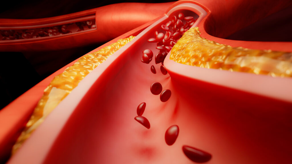 Next-generation blood thinner from Bristol Myers Squibb, J&J fails key trial